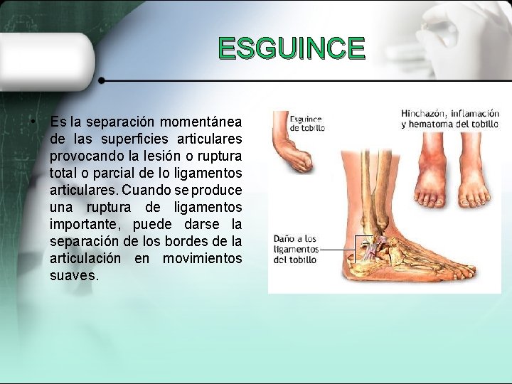 ESGUINCE • Es la separación momentánea de las superficies articulares provocando la lesión o