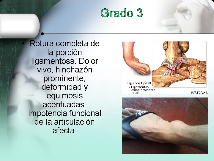 Grado 3 • Rotura completa de la porción ligamentosa. Dolor vivo, hinchazón prominente, deformidad