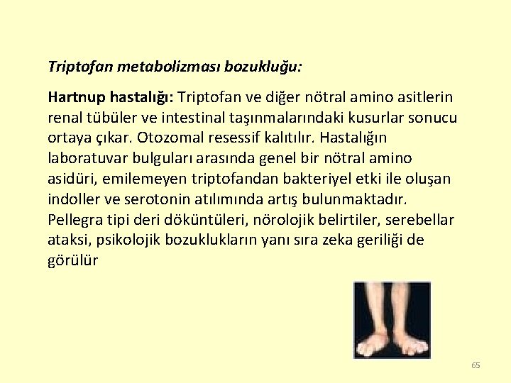 Triptofan metabolizması bozukluğu: Hartnup hastalığı: Triptofan ve diğer nötral amino asitlerin renal tübüler ve