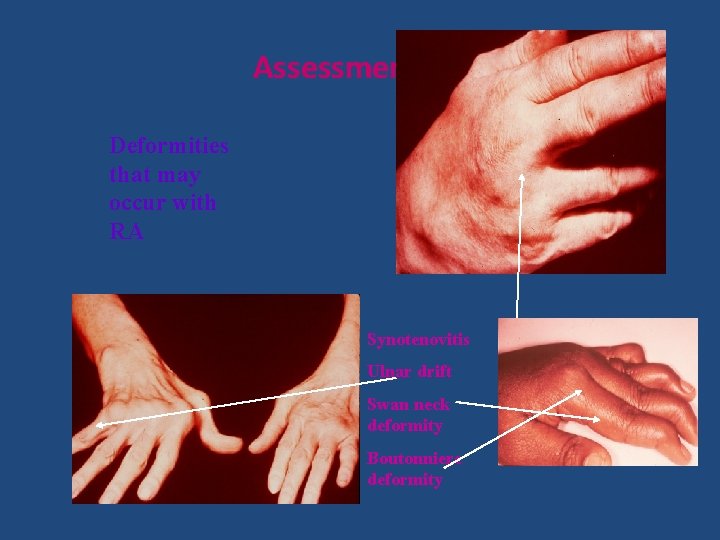 Assessment RA Deformities that may occur with RA Synotenovitis Ulnar drift Swan neck deformity