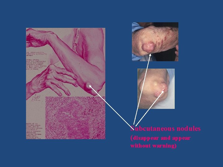 Subcutaneous nodules (disappear and appear without warning) 