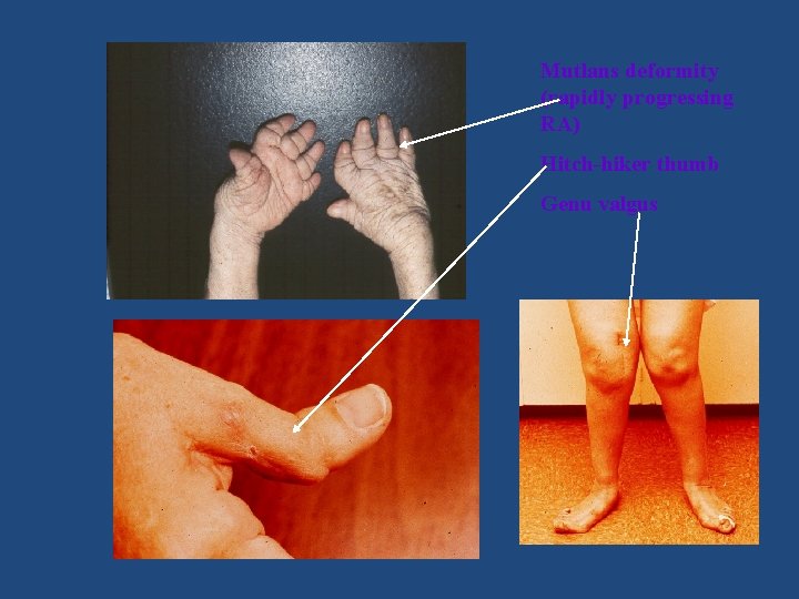 Mutlans deformity (rapidly progressing RA) Hitch-hiker thumb Genu valgus 