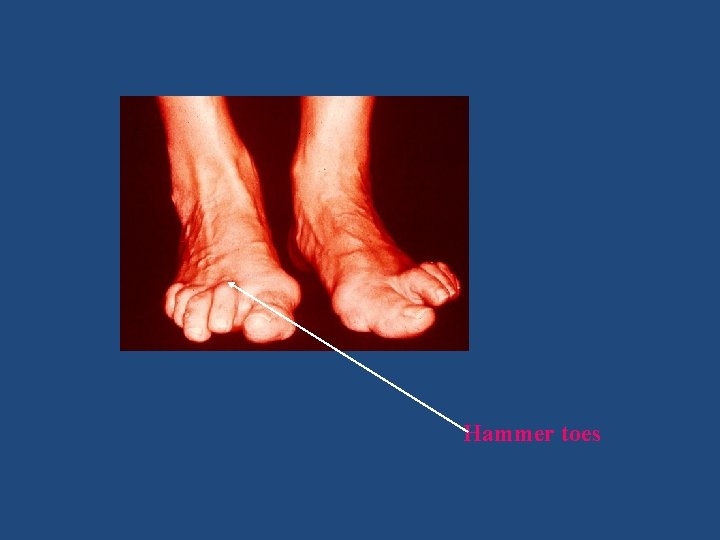 Hammer toes 