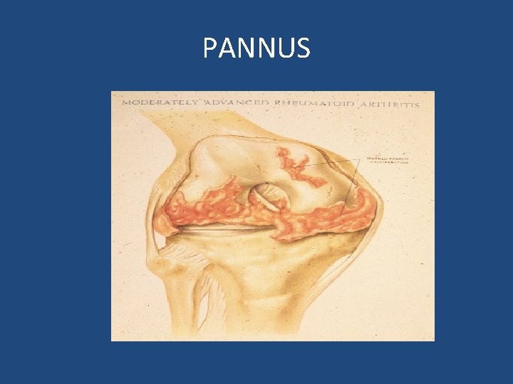 PANNUS 