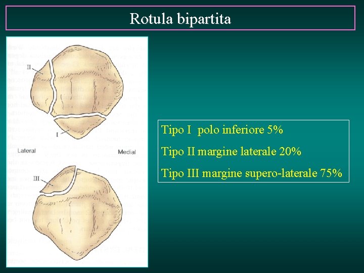 Rotula bipartita Tipo I polo inferiore 5% Tipo II margine laterale 20% Tipo III