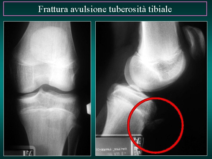 Frattura avulsione tuberosità tibiale 