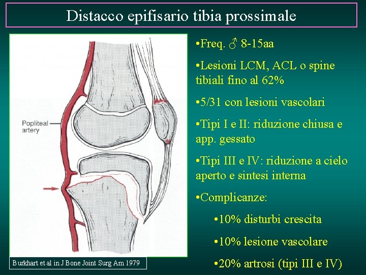 Distacco epifisario tibia prossimale • Freq. ♂ 8 -15 aa • Lesioni LCM, ACL