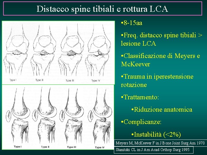 Distacco spine tibiali e rottura LCA • 8 -15 aa • Freq. distacco spine