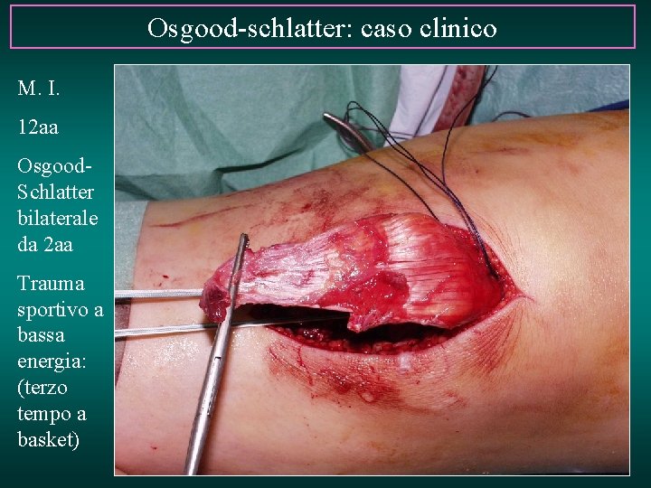 Osgood-schlatter: caso clinico M. I. 12 aa Osgood. Schlatter bilaterale da 2 aa Trauma