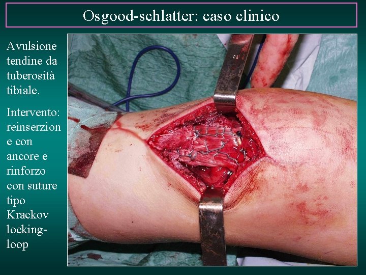 Osgood-schlatter: caso clinico Avulsione tendine da tuberosità tibiale. Intervento: reinserzion e con ancore e