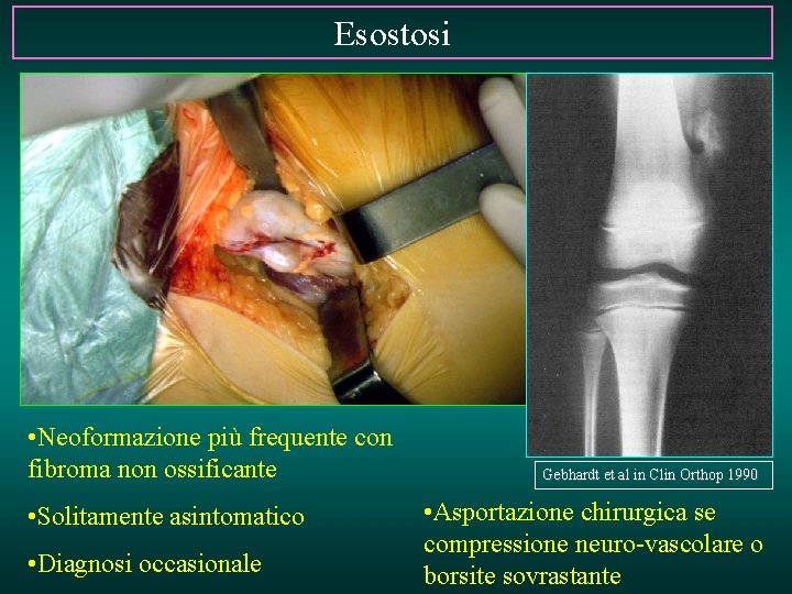 Esostosi • Neoformazione più frequente con fibroma non ossificante • Solitamente asintomatico • Diagnosi