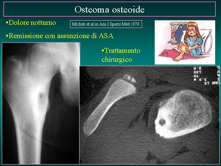 Osteoma osteoide • Dolore notturno Micheli et al in Am J Sports Med 1978
