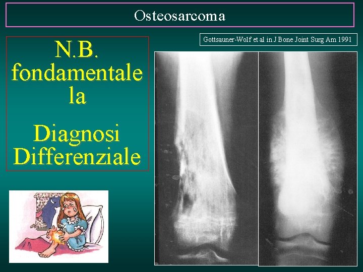 Osteosarcoma N. B. fondamentale la Diagnosi Differenziale Gottsauner-Wolf et al in J Bone Joint