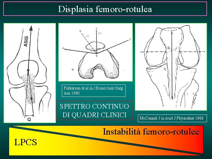 Displasia femoro-rotulea Fulkerson et al in J Bone Joint Surg Am 1990 SPETTRO CONTINUO