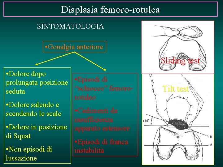 Displasia femoro-rotulea SINTOMATOLOGIA • Gonalgia anteriore Sliding test • Dolore dopo prolungata posizione • Displasia femoro-rotulea SINTOMATOLOGIA • Gonalgia anteriore Sliding test • Dolore dopo prolungata posizione •