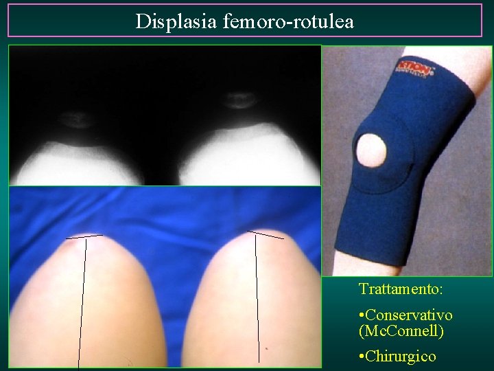 Displasia femoro-rotulea Trattamento: • Conservativo (Mc. Connell) • Chirurgico 