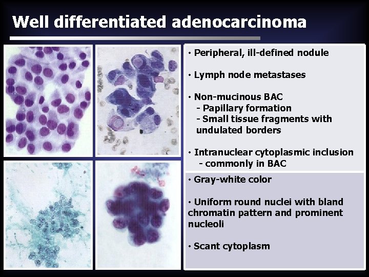 Well differentiated adenocarcinoma • Peripheral, ill-defined nodule • Lymph node metastases • Non-mucinous BAC