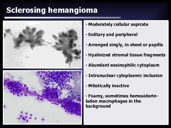 Sclerosing hemangioma • Moderately cellular aspirate • Solitary and peripheral • Arranged singly, in