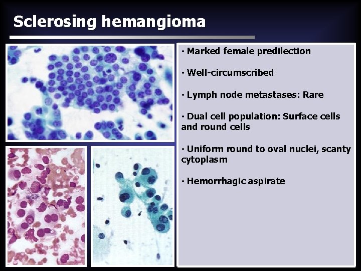 Sclerosing hemangioma • Marked female predilection • Well-circumscribed • Lymph node metastases: Rare •