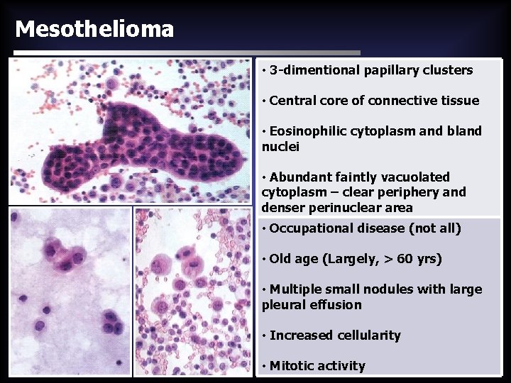Mesothelioma • 3 -dimentional papillary clusters • Central core of connective tissue • Eosinophilic