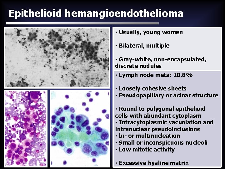 Epithelioid hemangioendothelioma • Usually, young women • Bilateral, multiple • Gray-white, non-encapsulated, discrete nodules