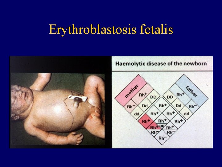 Erythroblastosis fetalis 