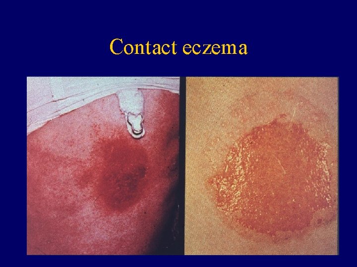 Contact eczema 