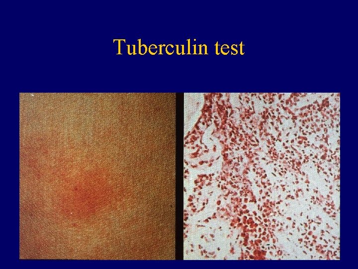 Tuberculin test 