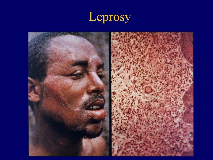 Leprosy 