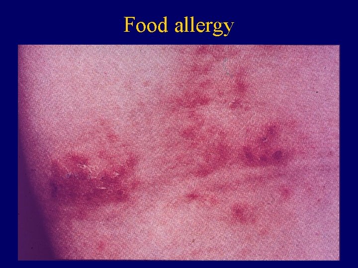 Food allergy 