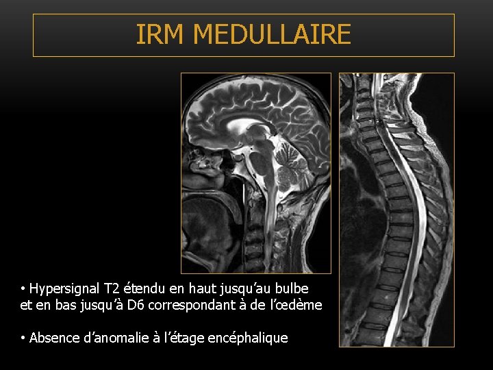 IRM MEDULLAIRE • Hypersignal T 2 étendu en haut jusqu’au bulbe et en bas IRM MEDULLAIRE • Hypersignal T 2 étendu en haut jusqu’au bulbe et en bas