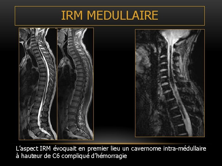 IRM MEDULLAIRE L’aspect IRM évoquait en premier lieu un cavernome intra-médullaire à hauteur de IRM MEDULLAIRE L’aspect IRM évoquait en premier lieu un cavernome intra-médullaire à hauteur de