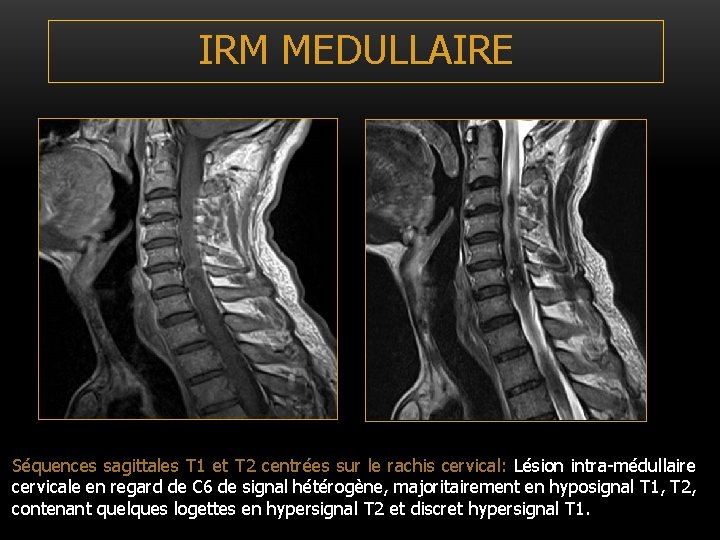 IRM MEDULLAIRE Séquences sagittales T 1 et T 2 centrées sur le rachis cervical: IRM MEDULLAIRE Séquences sagittales T 1 et T 2 centrées sur le rachis cervical: