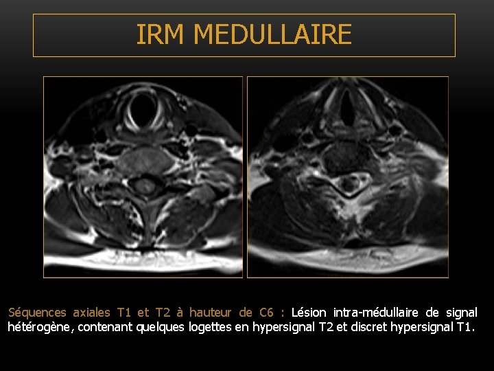 IRM MEDULLAIRE Séquences axiales T 1 et T 2 à hauteur de C 6 IRM MEDULLAIRE Séquences axiales T 1 et T 2 à hauteur de C 6