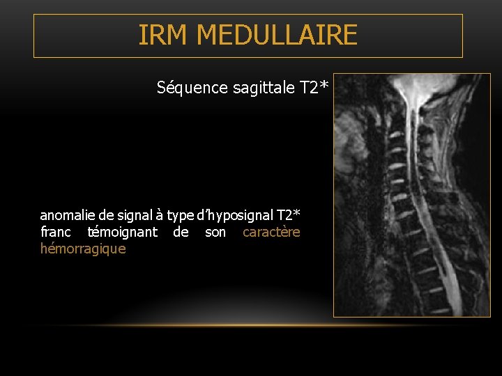 IRM MEDULLAIRE Séquence sagittale T 2* anomalie de signal à type d’hyposignal T 2* IRM MEDULLAIRE Séquence sagittale T 2* anomalie de signal à type d’hyposignal T 2*