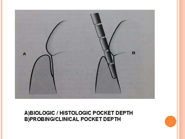 A)BIOLOGIC / HISTOLOGIC POCKET DEPTH B)PROBING/CLINICAL POCKET DEPTH 