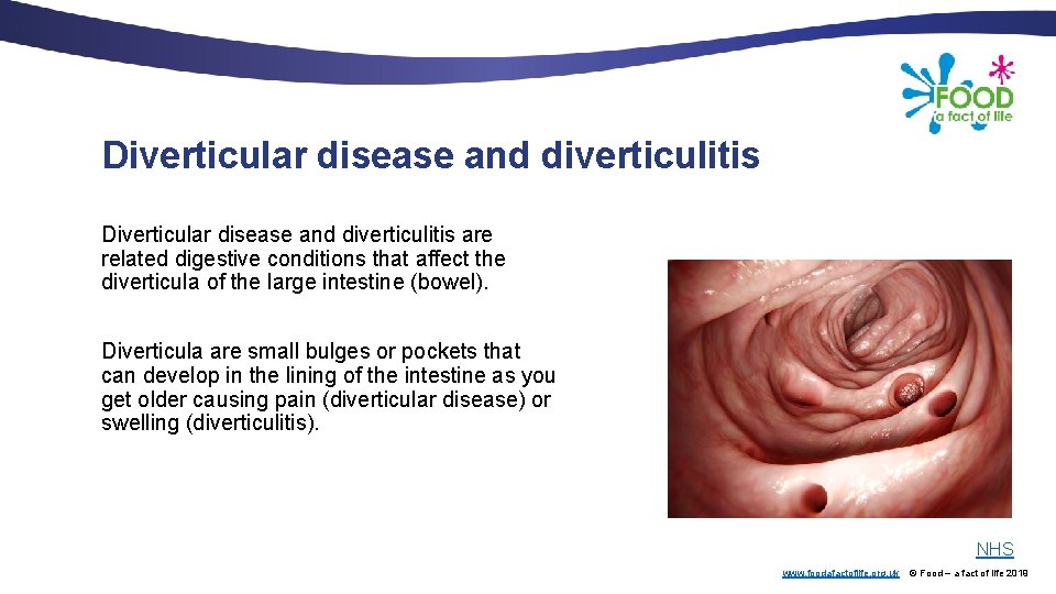 Diverticular disease and diverticulitis are related digestive conditions that affect the diverticula of the