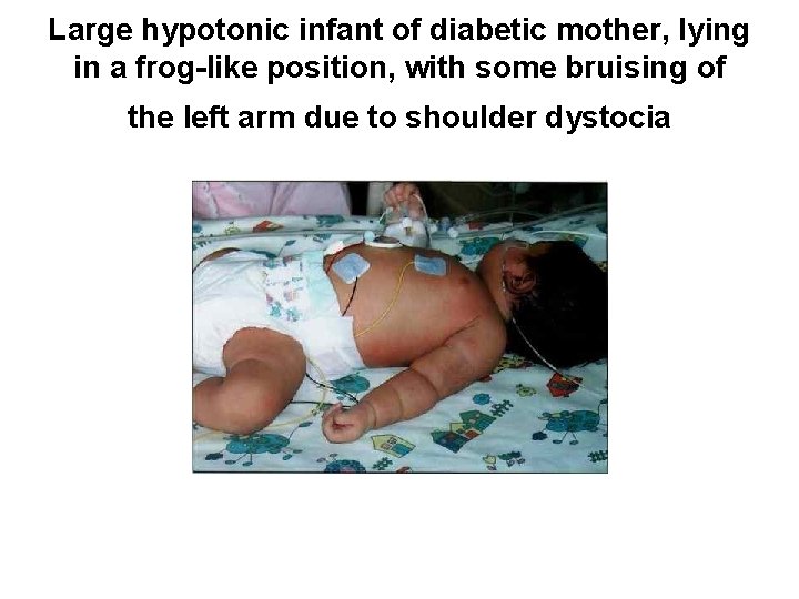 Large hypotonic infant of diabetic mother, lying in a frog-like position, with some bruising