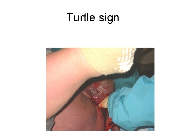 Turtle sign 