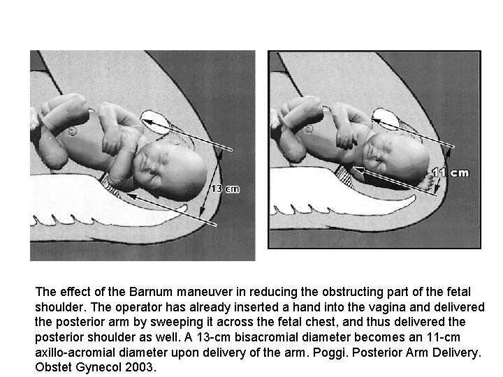 The effect of the Barnum maneuver in reducing the obstructing part of the fetal