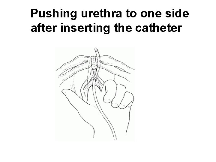  Pushing urethra to one side after inserting the catheter 