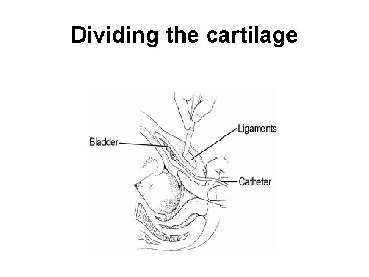 Dividing the cartilage 