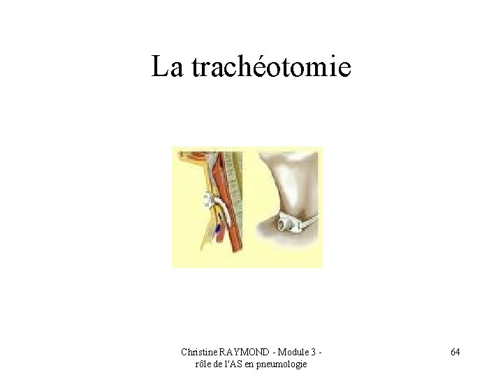 La trachéotomie Christine RAYMOND - Module 3 rôle de l'AS en pneumologie 64 