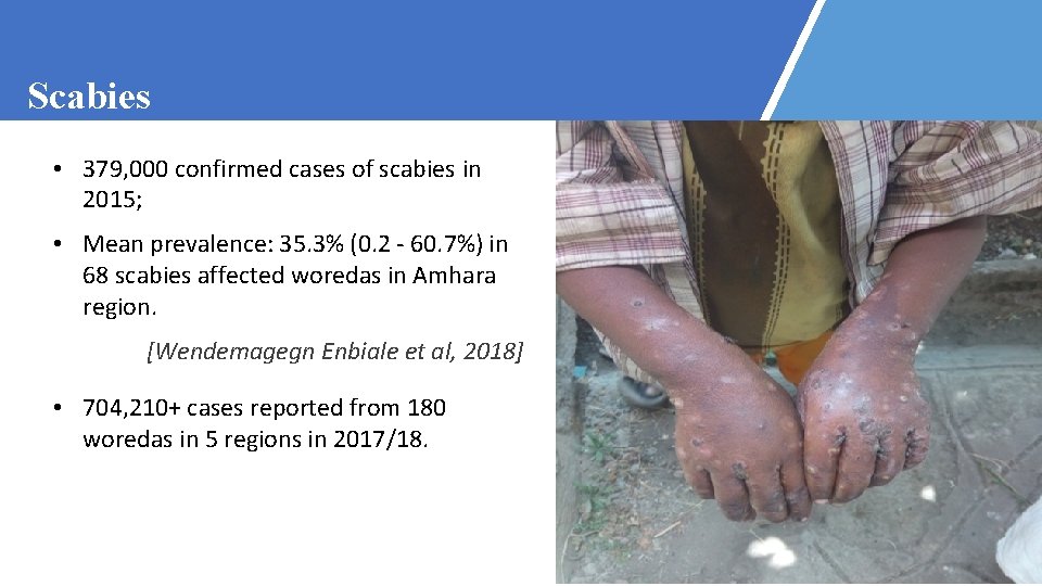 Scabies • 379, 000 confirmed cases of scabies in 2015; • Mean prevalence: 35.