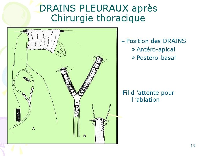 DRAINS PLEURAUX après Chirurgie thoracique – Position des DRAINS » Antéro-apical » Postéro-basal •