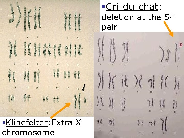 §Cri-du-chat: deletion at the 5 th pair §Klinefelter: Extra X chromosome 