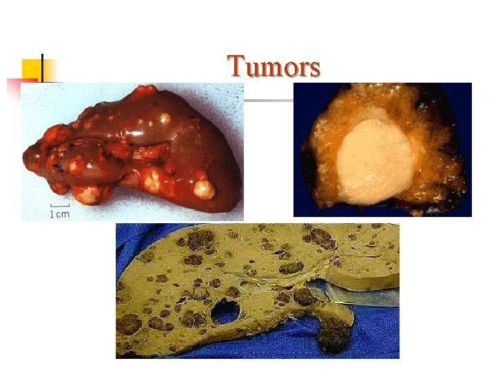 Tumors 