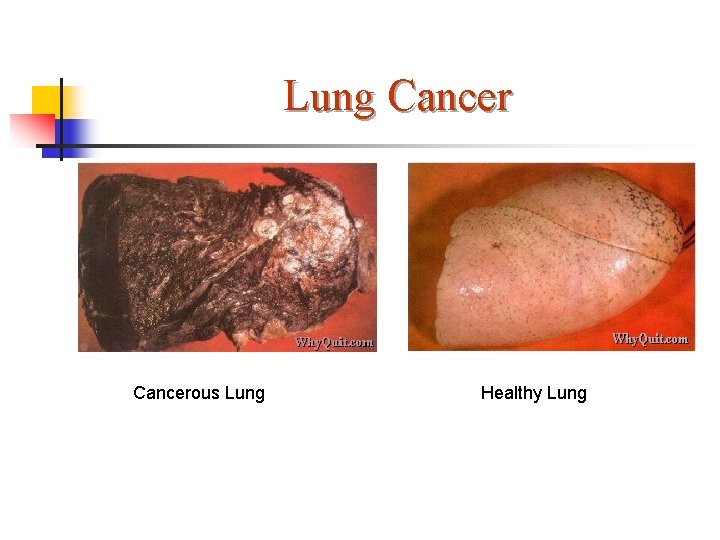 Lung Cancerous Lung Healthy Lung 