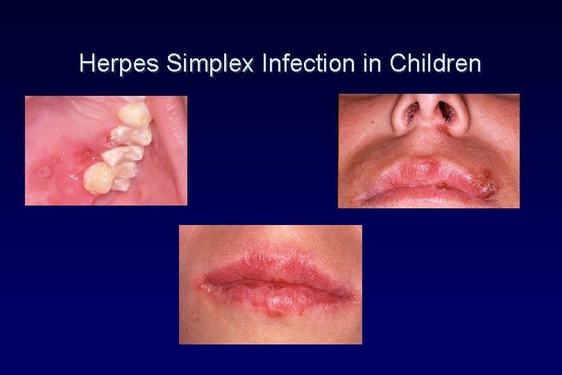 Herpes Simplex Infection in Children Herpes Simplex Infection in Children