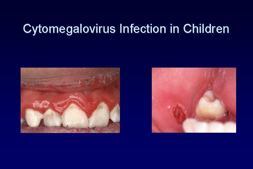 Cytomegalovirus Infection in Children Cytomegalovirus Infection in Children